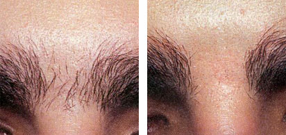 Ingrown hair brazilian laser hair removal before and after photos. 